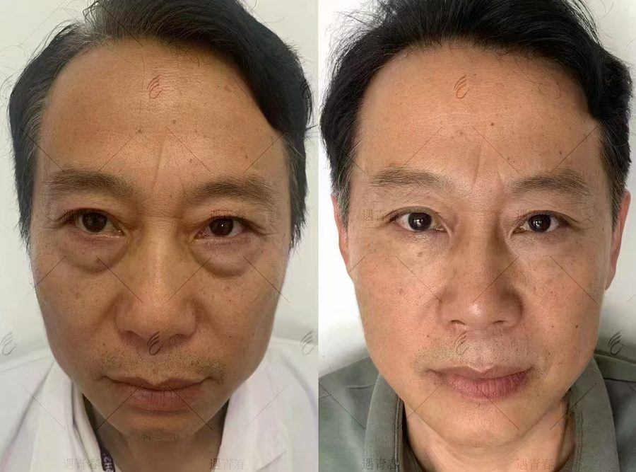 眼周年轻化前后对比