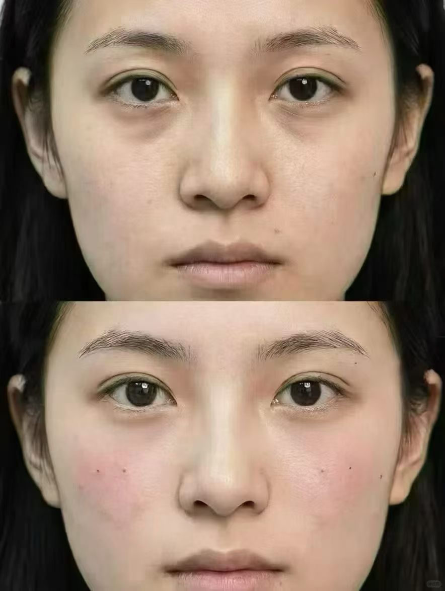 年轻群体针孔式去眼袋案例